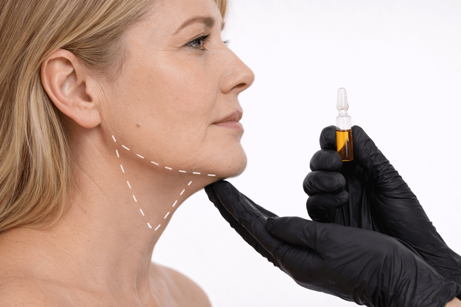 Tratamiento de papada mediante técnicas no quirúrgicas como enzimas y mesoterapia. La combinación de procedimientos de medicina estética permite reducir el doble mentón y mejorar el perfil facial de forma progresiva. Tratamiento de papada en la zona norte de Madrid.