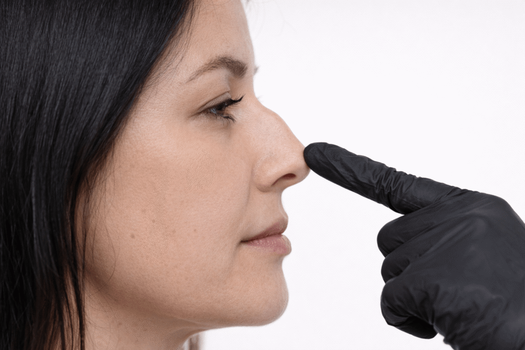 La rinomodelación con ácido hialurónico permite corregir pequeñas gibas o punta nasal caída sin intervención quirúrgica. Tratamiento de medicina estética nasal que mejora el perfil de forma inmediata y reversible. Rinomodelación sin cirugía en la zona norte de Madrid.