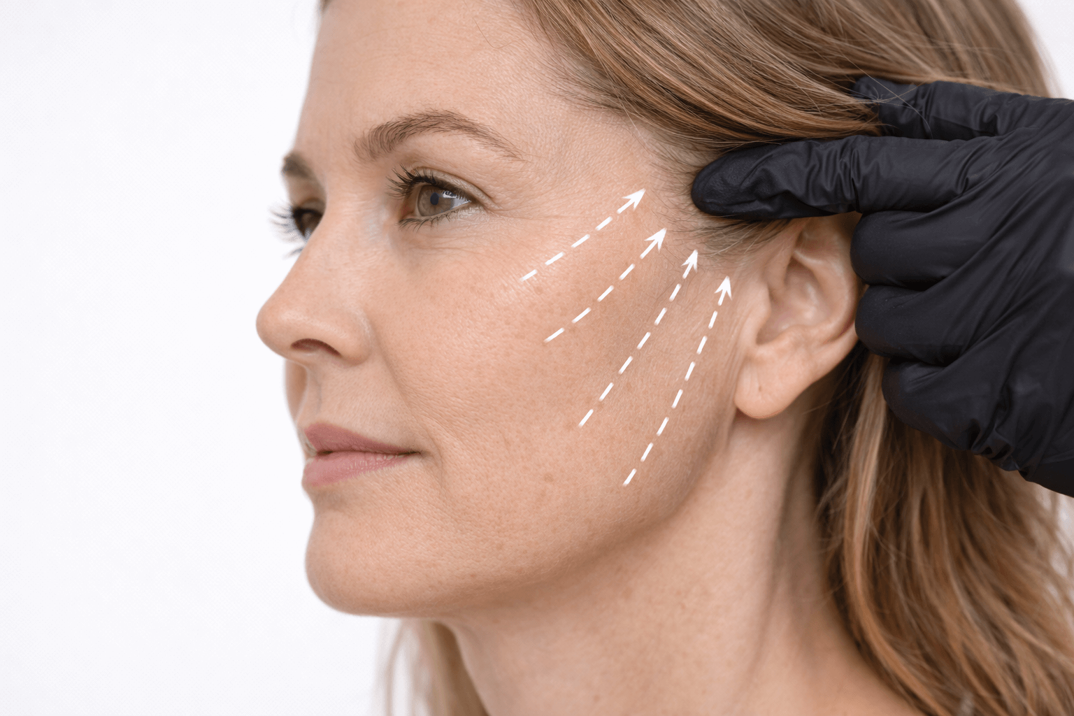 Tratamiento con hilos tensores reabsorbibles para reposicionar los tejidos y combatir la flacidez facial. Produce un efecto lifting progresivo sin cirugía, estimulando la producción de colágeno. Hilos tensores en medicina estética avanzada en la zona norte de Madrid.